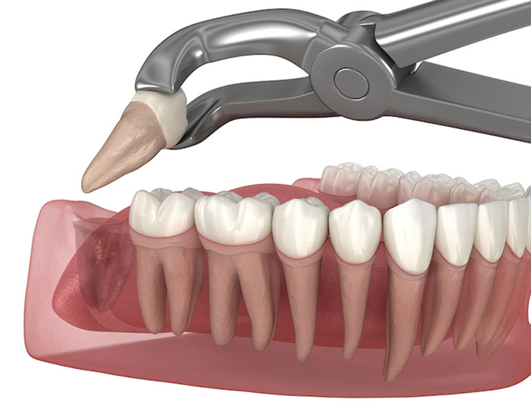 Exploring Tooth Replacement Options