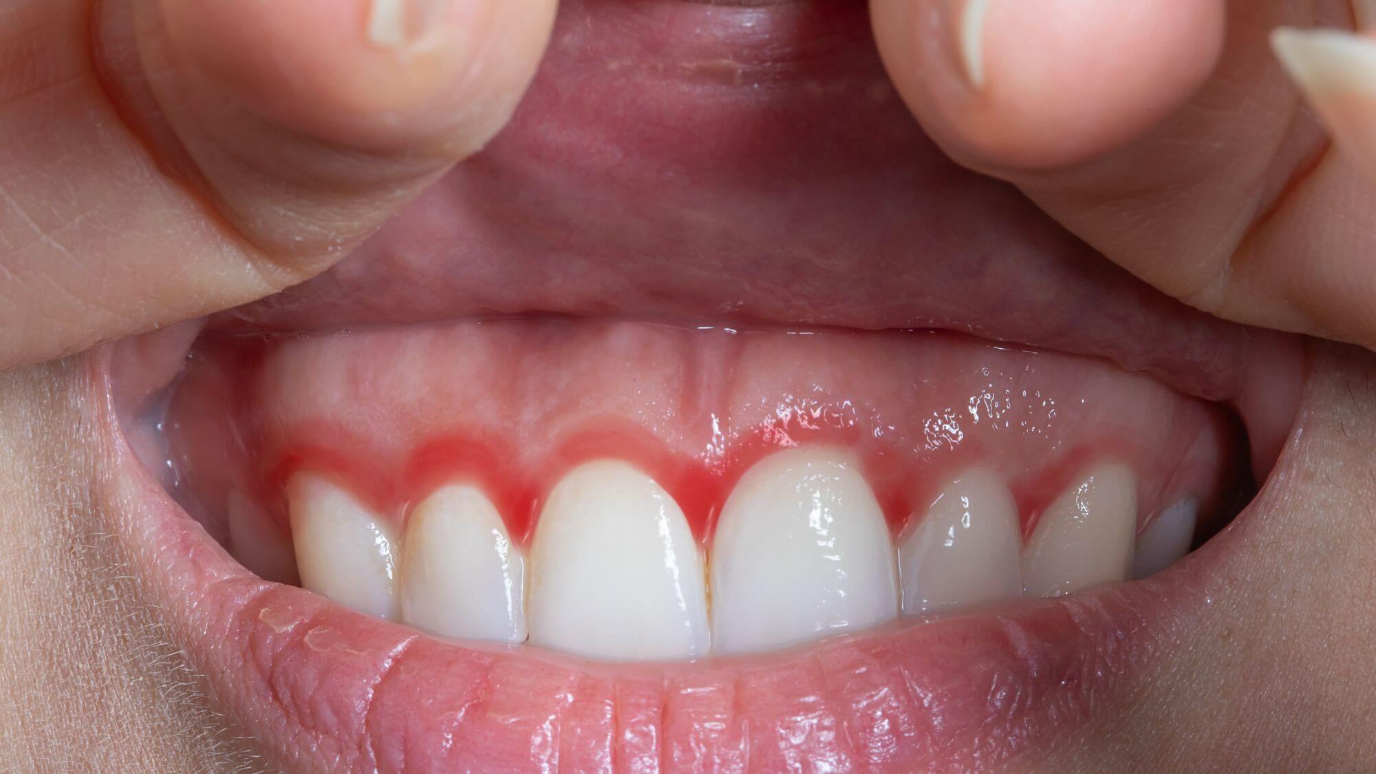 A pregnant woman showing bleeding gums to demonstrate is gingivitis contagious awareness
