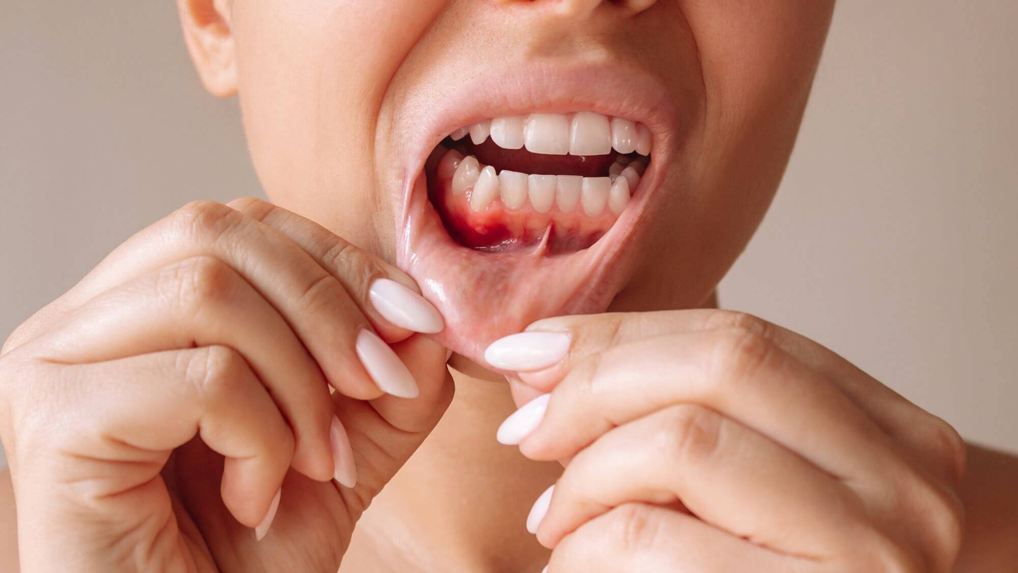 A stressed woman showing gum irritation to highlight is gingivitis contagious concerns
