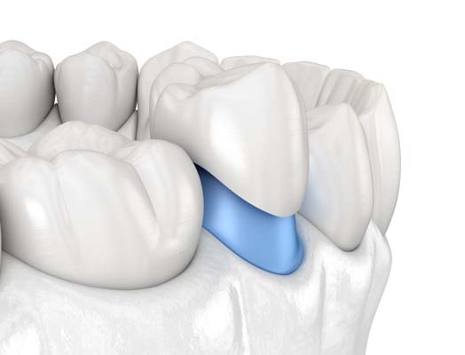 Tips To Help Dental Crowns Last Longer